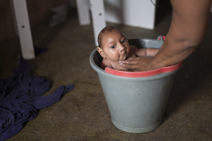 Brezilya'da mikrosefali anomalisinesahip bir bebek. Fotoğraf: Felipe Dana / AP / Via apimages.com
